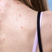 Ucapkan Selamat Tinggal Backne dengan 5 Body Wash Ini