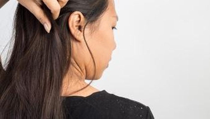 Kenali Penyebab Serta Cara Mengatasi Kulit Kepala Gatal dan Ketombe Membandel