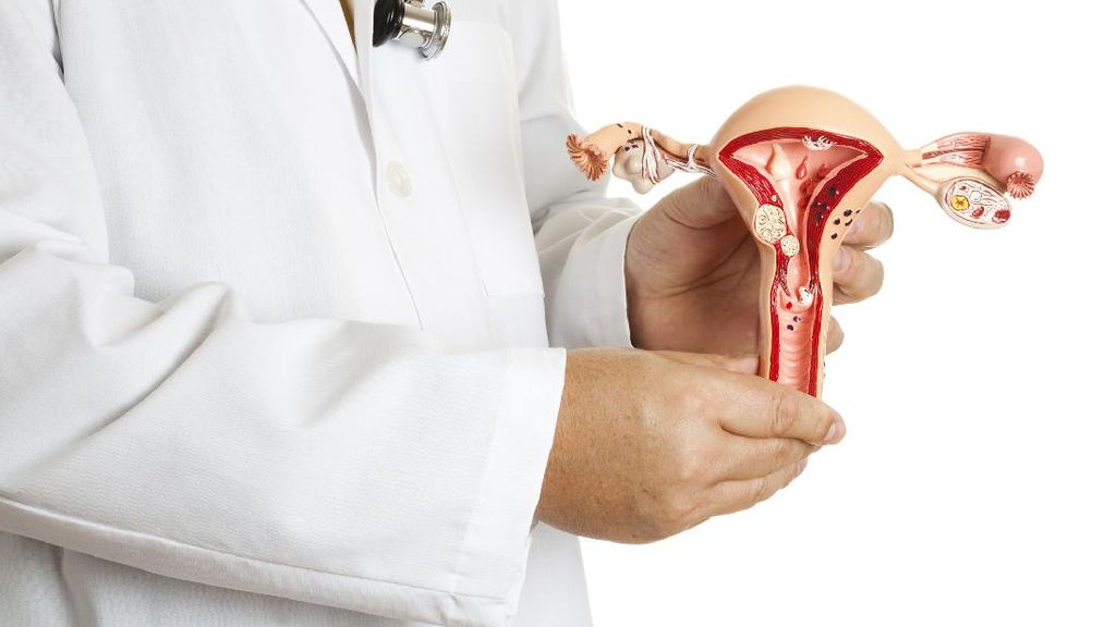 Disangka Stres dan Maag, Wanita Surabaya Ternyata Idap Kista 33 Cm