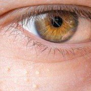 Sama-sama Muncul di Area Mata, Simak Perbedaan Milia dan Syringoma