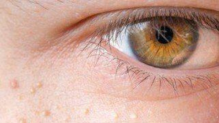 Sama-sama Muncul di Area Mata, Simak Perbedaan Milia dan Syringoma