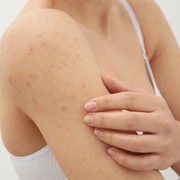 5 Tips Sederhana Agar Bebas dari Body Acne