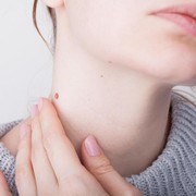 5 Cara Mudah Atasi Kutil dengan Bahan Alami, Cukup Lakukan di Rumah!