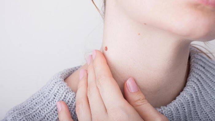 5 Cara Mudah Atasi Kutil dengan Bahan Alami, Cukup Lakukan di Rumah!