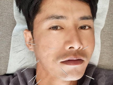 Penyanyi Tampan Korea Alami Lumpuh Wajah, Begini Pengobatannya