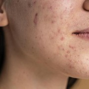 7 Cara Atasi Wajah Breakout Karena Olahraga