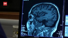 VIDEO: Kontroversi Aduhelm, Obat Alzheimer Asal AS