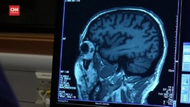 VIDEO: Kontroversi Aduhelm, Obat Alzheimer Asal AS
