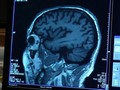 VIDEO: Kontroversi Aduhelm, Obat Alzheimer Asal AS