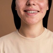 5 Cara Alami Hilangkan Bekas Jerawat