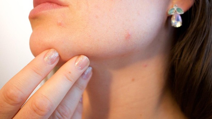 Mitos atau Fakta, Letak Jerawat di Wajah Bisa Tunjukkan Kondisi Kesehatan Tubuh Seseorang? Mitos atau Fakta, Letak Jerawat di Wajah Bisa Tunjukkan Kondisi Kesehatan Tubuh Seseorang?