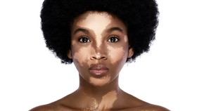 Tema dan Sejarah Hari Vitiligo Sedunia 2024