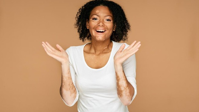 Perlakuan diskriminatif kerap dirasakan para penderita vitiligo. Mulai dari sulit dapat kerja, dilihat sebagai aib, hingga dianggap sebagai penyakit menular.