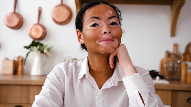 Vitiligo merupakan kelainan atau penyakit yang menyerang pigmen kulit hingga muncul bercak putih di beberapa area tubuh. Apakah vitiligo bisa diobati?