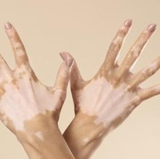 Kenali Vitiligo, Penyakit Kulit yang Disebabkan Auto Imun
