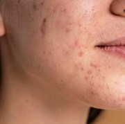 4 Pilihan Skincare untuk Memperkuat Skin Barrier