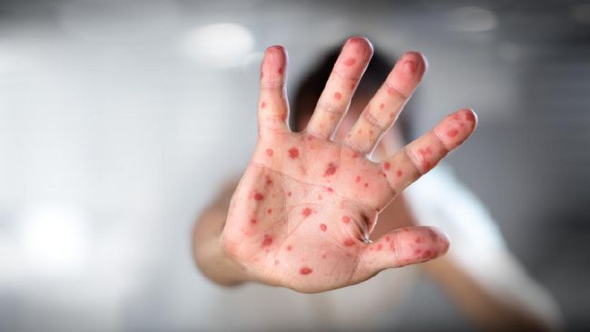 Campak seringkali disamakan dengan rubella. Apa beda campak dan rubella?