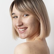 Cantik Tanpa Makeup Walau Sedang Berjerawat? Pede Aja, Ikuti 4 Kiat Berikut ini!