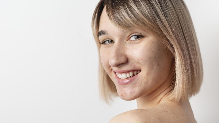Cantik Tanpa Makeup Walau Sedang Berjerawat? Pede Aja, Ikuti 4 Kiat Berikut ini!