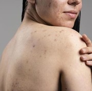 Selain di Wajah, Jerawat Juga Kerap Tumbuh di 3 Bagian Tubuh Ini