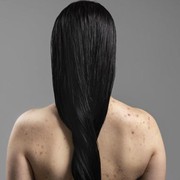 Bukan Cuma Hindari Pakaian yang Ketat, Berikut Trik Jitu Cegah Munculnya Jerawat di Badan