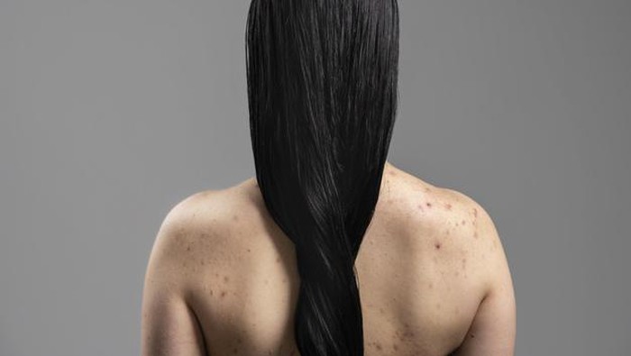 Bukan Cuma Hindari Pakaian yang Ketat, Berikut Trik Jitu Cegah Munculnya Jerawat di Badan