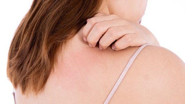 Penyebab Eksim dan Kandungan Terbaik dalam Skincare untuk Mengobatinya, Dicoba Yuk!