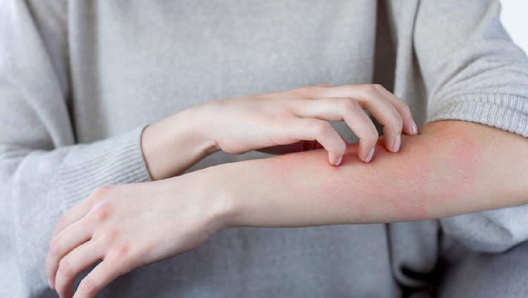 Ilustrasi Alergi Closeup girl is scratching her hand with nails. Reddened, inflamed body parts causes discomfort and itching. Young woman is suffering from bouts of allergies. Dermatological skin diseases concept.