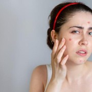 5 Merk Pembersih Jerawat Paling Mujarab untuk Hempas Jerawat Membandel