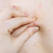 Selain Kondisi Rambut yang Kotor, Ini 5 Faktor Pemicu Munculnya Jerawat di Badan