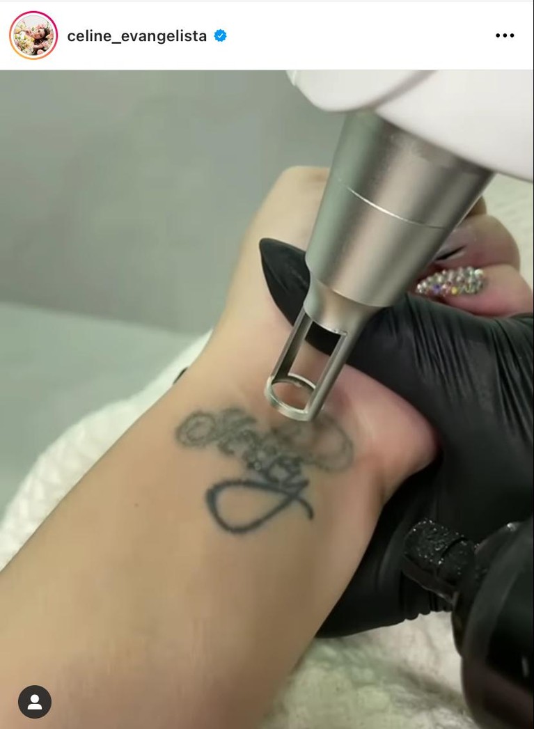 Proses Penghapusan Tato Celine Evangelista Yuk intip bagaimana proses penghapusan tato Celine!