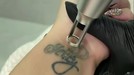 Proses Penghapusan Tato Celine Evangelista Proses Penghapusan Tato Celine Evangelista