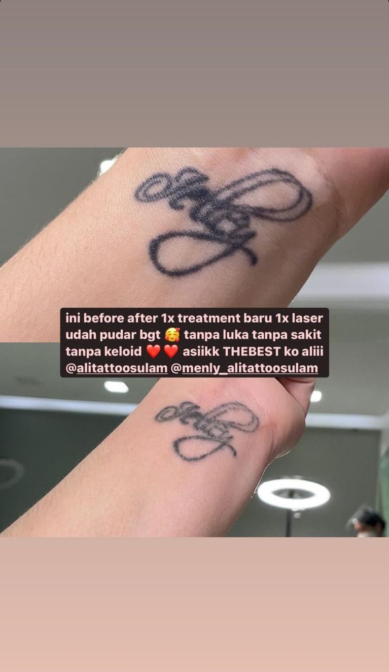 Proses Penghapusan Tato Celine Evangelista Yuk intip bagaimana proses penghapusan tato Celine!