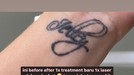 Proses Penghapusan Tato Celine Evangelista Proses Penghapusan Tato Celine Evangelista