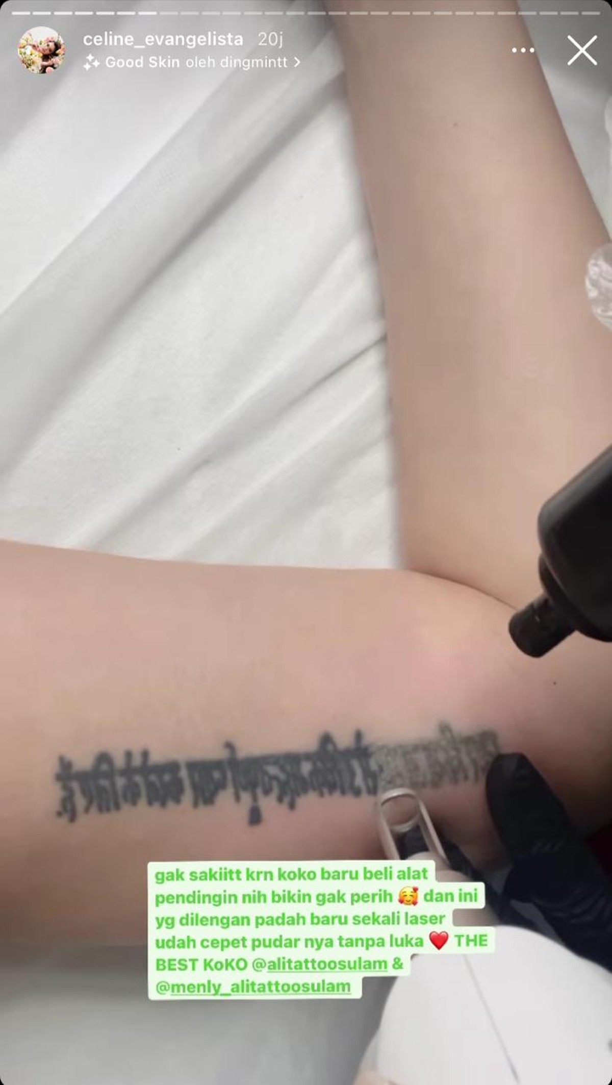 Yuk intip bagaimana proses penghapusan tato Celine&excl;