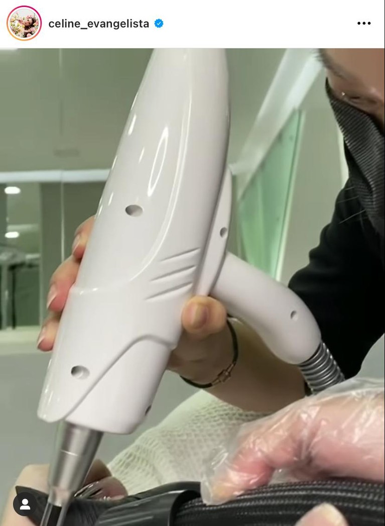 Proses Penghapusan Tato Celine Evangelista Yuk intip bagaimana proses penghapusan tato Celine!