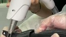 Proses Penghapusan Tato Celine Evangelista Proses Penghapusan Tato Celine Evangelista