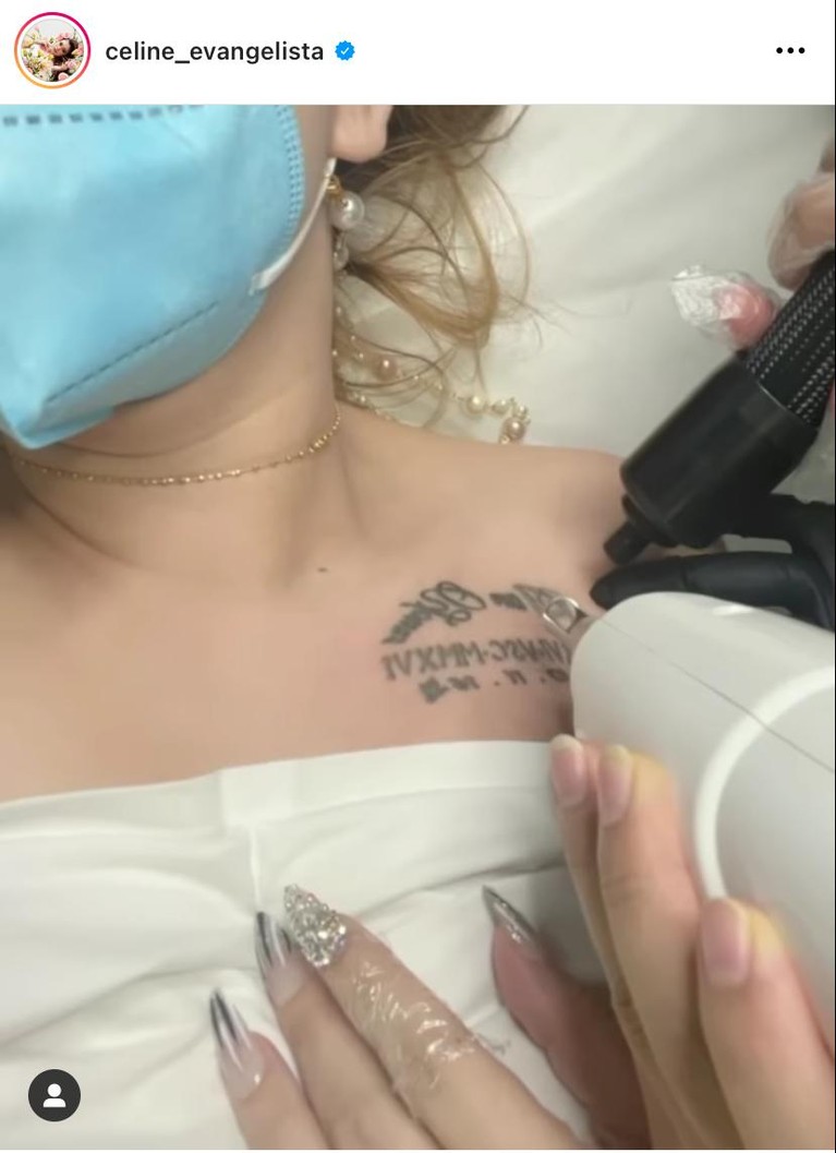 Yuk intip bagaimana proses penghapusan tato Celine!