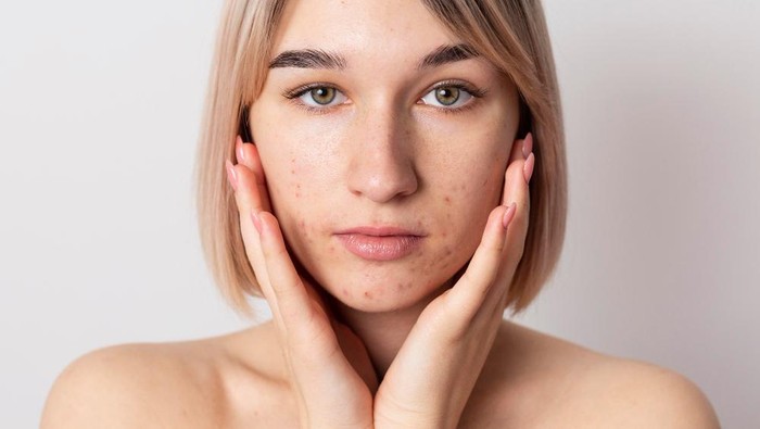 Stop Acne Shaming! Bisa Sebabkan Gangguan Mental Karena Masalah Jerawat