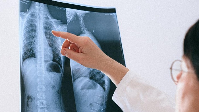 Tingkatkan Kualitas Paru-Paru, Ini Jurus yang Bisa Kamu Lakukan