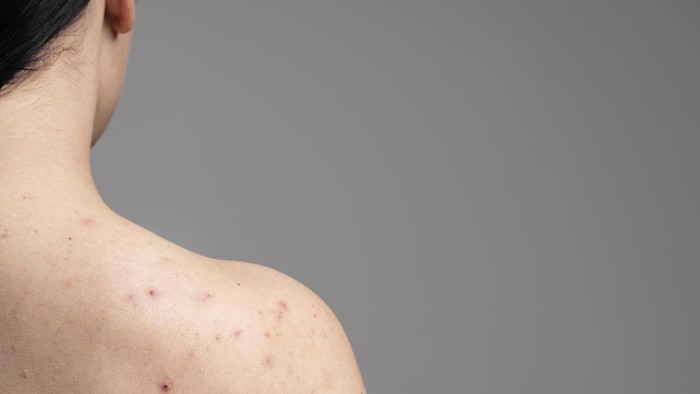 Sering Gatal dan Bikin Nggak Nyaman, Atasi Masalah Jerawat Punggung dengan 4 Skincare Ini