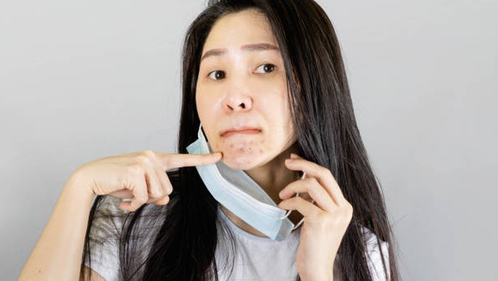 21 Hari Kebiasaan Baik yang Bisa Bantu Mengurangi Jerawat