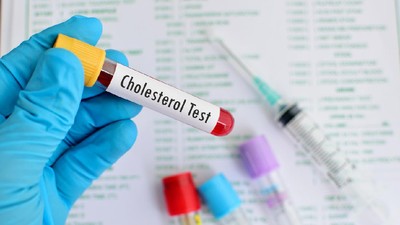 Kolesterol Tinggi Bisa Dialami Anak Muda, Ketahui Alasan dan Bahayanya
