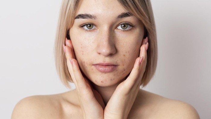 Jerawat Muncul di Dagu, Tanda Tubuhmu Sedang Alami Hal Ini!