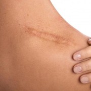 5 Bahan Alami Rumahan untuk Menghilangkan Bekas Luka