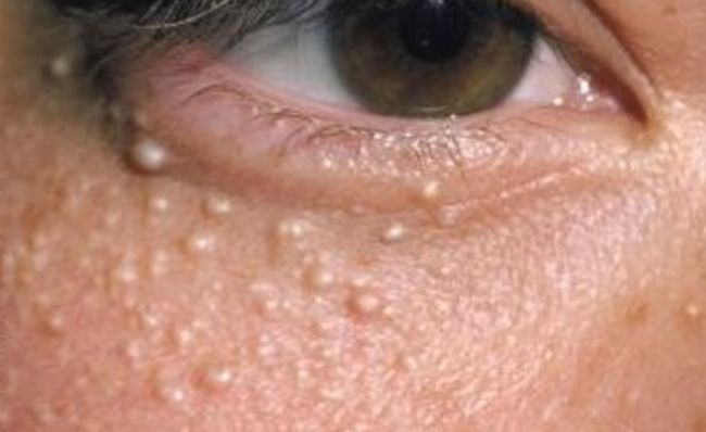 4 Cara Membasmi Milia di Bawah Mata Hingga Tak Muncul Lagi