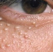 4 Cara Membasmi Milia di Bawah Mata Hingga Tak Muncul Lagi