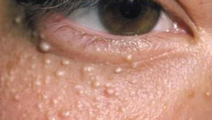4 Cara Membasmi Milia di Bawah Mata Hingga Tak Muncul Lagi