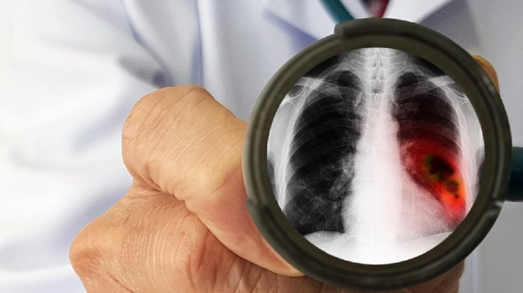 Doctor's physical examination for screening lung cancer
