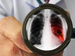 Studi Lagi-lagi Buktikan Bahaya Vape Bagi Paru-paru
